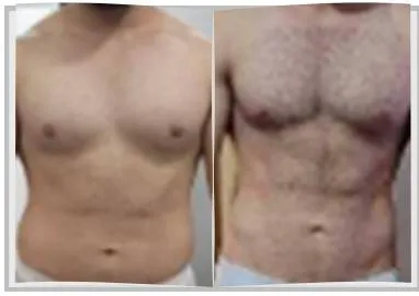 Foto de antes e depois de um paciente do Adriano, lado a lado