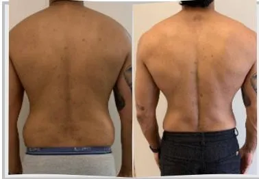 Foto de antes e depois de um paciente do Adriano, lado a lado