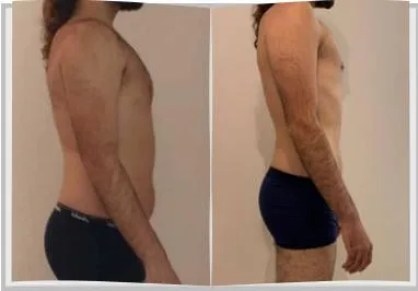 Foto de antes e depois de um paciente do Adriano, lado a lado