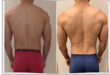 Foto de antes e depois de um paciente do Adriano, lado a lado