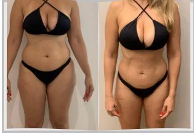 Foto de antes e depois de um paciente do Adriano, lado a lado