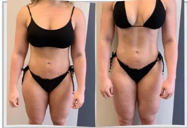 Foto de antes e depois de um paciente do Adriano, lado a lado