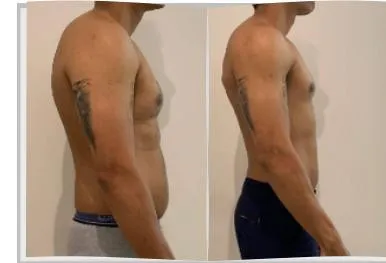 Foto de antes e depois de um paciente do Adriano, lado a lado
