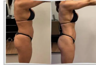 Foto de antes e depois de um paciente do Adriano, lado a lado