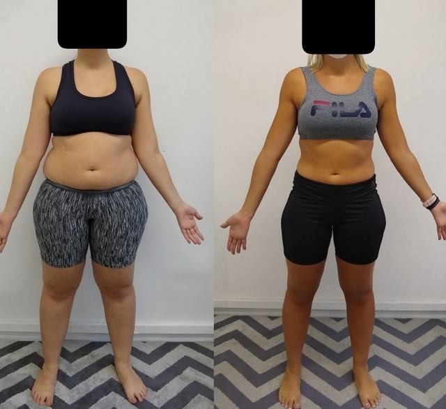Antes e depois de paciente no emagrecimento